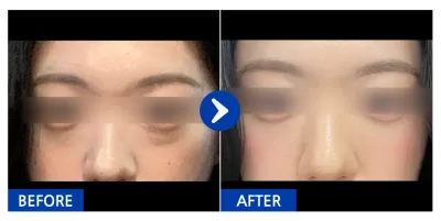 [Gangnam Unni] Tái định vị mỡ mí mắt dưới / Tháng thứ 1 / Biệt danh: Mingminghan-gyul