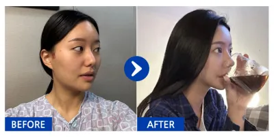 [Babytalk] Phẫu thuật nâng mũi, gọt mặt 3 vùng (gò má, hàm vuông, cằm) / Tháng thứ 3 / Biệt danh: Park Tten-tten