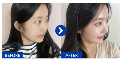 [Babitalk] Phẫu thuật nâng mũi, cấy mỡ trán / Tuần thứ 2 / Biệt danh: Nyang Nyang Nyang Woong Woong