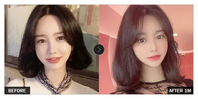 [Review Babitalk] Thẩm mỹ mắt sau một tháng / Biệt danh: y3409