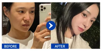 [Babytalk] Phẫu thuật nâng mũi / Tuần 1 / Biệt danh: Quokkau0VdN