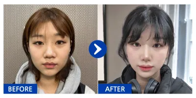 [Babitalk] Phẫu thuật nâng mũi / Tháng thứ 1 / Biệt danh: Nananananan-ni