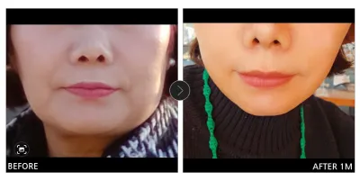 [Review Gangnam Unni] Căng da mặt mini / Tháng thứ 1 / Biệt danh: Smile (Min-kyung)