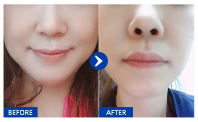 [Review trên Gangnam Unni] Căng da mặt mini / Tháng thứ 1 / Biệt danh: Hongdae Manyeo