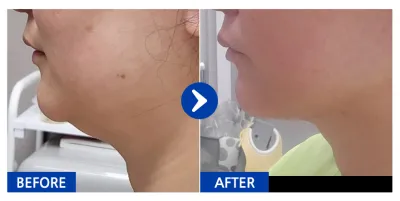 [Gangnam Unni] Hút mỡ / Lần 1 / Biệt danh: Mẹ yêu Seojun