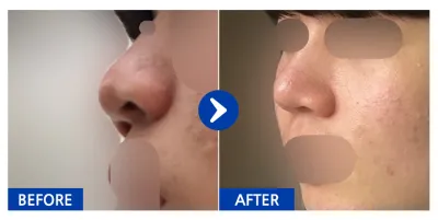 [Gangnam Unni] Mũi / 1 tháng / Biệt danh: Lee Ga-on 12