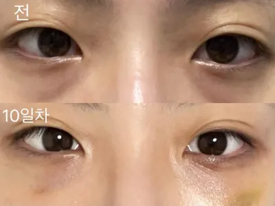 [Gangnam Unni] Tái định vị mỡ mắt dưới / Ngày thứ 10 / Biệt danh: suntree