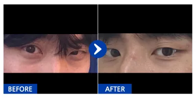 [Gangnam Unni] Tái cấu trúc mỡ bọng mắt / Tháng thứ 3 / Biệt danh: Shinbang Baek-seonsaeng