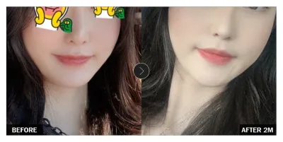 [Review Gangnam Unni] Phẫu thuật tạo hình khuôn mặt tháng thứ hai / Biệt danh: yrBang