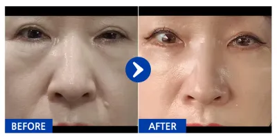 [Gangnam Unni] Phẫu thuật hạ mi mắt + Cấy mỡ / Tháng thứ 1 / Biệt danh: Sansuhyang