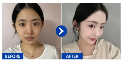 [Gangnam Unni] Nâng mũi / Tháng thứ 3 / Biệt danh: nyangnyangnyang-ung-ung