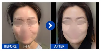 [Babitalk] Phẫu thuật đường nét khuôn mặt 2 vùng (gò má, hàm vuông) / Tháng thứ 1 / Biệt danh: Tokki65Nsj