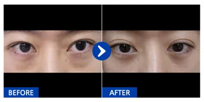 [Babitalk] Tái định vị mỡ mắt dưới / Sau 1 tháng / Biệt danh: 냥이KdOcl