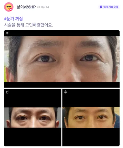 [Babytalk] Tái định vị mỡ bọng mắt / Tháng thứ 2 / Biệt danh: 냥이v26HP