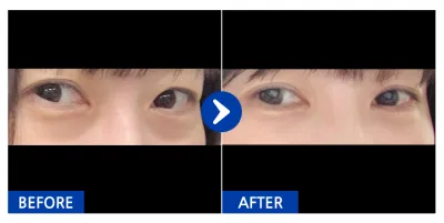 [Gangnam Unni] Tái cấu trúc mỡ mí dưới / 1 tháng / Biệt danh: Moontan