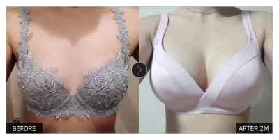 [Review Gangnam Unni] Phẫu thuật nâng ngực tháng thứ 2 / Biệt danh: Bithing