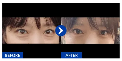 [Gangnam Unni] Tái định vị mỡ dưới mắt / 1 tháng / Biệt danh: Icepea