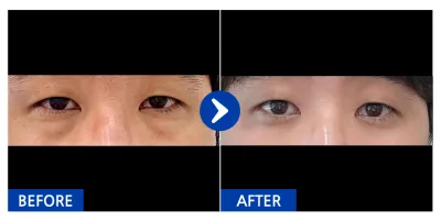 [Gangnam Unni] Tái định vị mỡ dưới mắt / Sau 1 tháng / Biệt danh: Pengberry