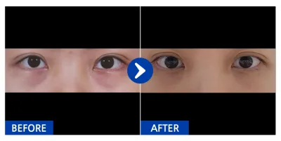 [Gangnam Unni] Tái định vị mỡ mí mắt dưới / Sau 1 tháng / Biệt danh: Yap-ssi