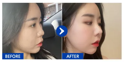 [Gangnam Unni] Nâng mũi / Tháng thứ 1 / Biệt danh: 드르르륵드르륵