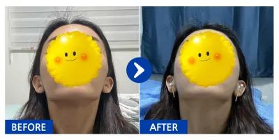 [Babitalk] Hạ gò má / Tháng thứ 1 / Biệt danh: Chiiiiicken