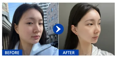 [Gangnam Unni] Phẫu thuật mũi, tạo hình khuôn mặt 2 vùng (gò má, hàm vuông) / 1 tháng / Biệt danh: Ko-al-li-eo