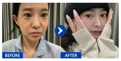 [Gangnam Unni] Phẫu thuật lại mũi / Tháng thứ 2 / Biệt danh: Hairuikba