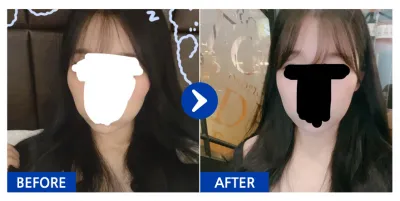 [Gangnam Unni] Hạ gò má tháng thứ 3 / Biệt danh: Là tại đôi mắt không đều;