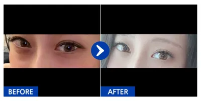 [Gangnam Unni] Tái cấu trúc mỡ dưới mắt / 1 tháng / Biệt danh: Mongdung-i Nuna