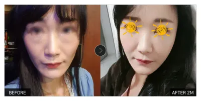 [Review Gangnam Unni] Cấy mỡ toàn mặt + Tái cấu trúc mỡ mí mắt dưới tháng thứ 2 / Biệt danh: Lavine