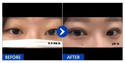 [Gangnam Unni] Nhấn mí tự nhiên / 1 tháng / Biệt danh: easyn