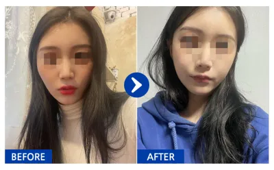 [Babytalk] Phẫu thuật khuôn mặt / Tháng thứ 1 / Biệt danh: Boreueumdal