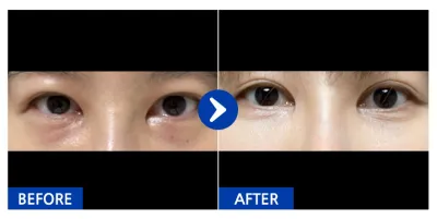 [Gangnam Unni] Tái cấu trúc mỡ mắt dưới / Sau 1 tháng / Biệt danh: anjjjjjjj_