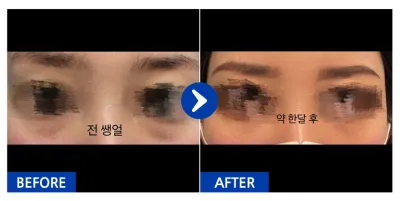 [Gangnam Unni] Tái định vị mỡ mí mắt dưới / Sau 1 tháng / Biệt danh: 쑈롱