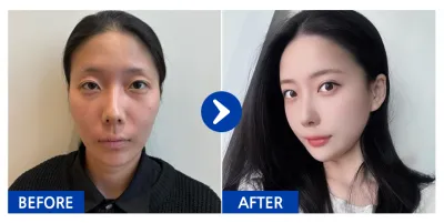 [Babitalk] Phẫu thuật gọt mặt 3 vùng, chỉnh hình sụp mí, cắt mí mắt, tái định vị mỡ mí dưới, cấy mỡ (má, trán) / Sau 1 tháng / Biệt danh: 갱쥐Y8tvn