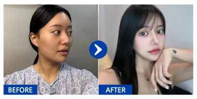 [Babitalk] Phẫu thuật gọt mặt 3 vùng, nâng mũi / Tháng thứ 6 / Biệt danh: Park Ttaen-ttaen