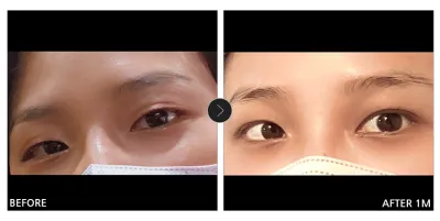 [Review Gangnam Unni] Phẫu thuật mắt sau một tháng / Biệt danh: Tatu mệt mỏi