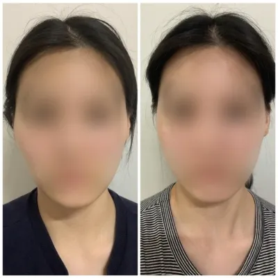 [Review trên Gangnam Unni] Một tháng sau phẫu thuật gọt mặt / Biệt danh: Dobimera