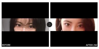 [Review trên Babitalk] Tái định vị mỡ mí mắt dưới tuần thứ 2 / Biệt danh: Mae-i-ra