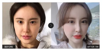 [Review trên Gangnam Unni] Phẫu thuật mắt tròn một tháng / Biệt danh: 2233332222