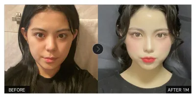 [Review Gangnam Unni] Cấy mỡ mặt tròn một tháng / Biệt danh: Damgongmaindu