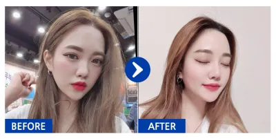 [Babitalk] Nâng mũi / Tháng thứ 5 / Biệt danh: Dyongdyong-i-ing