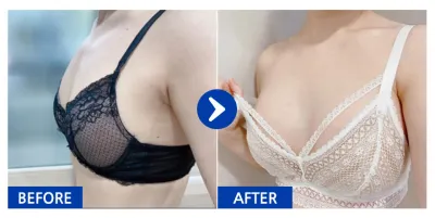 [Gangnam Unni] Phẫu thuật nâng ngực (Sebbin Sublimity) / Tháng thứ 1 / Biệt danh: Jjaeyuyu