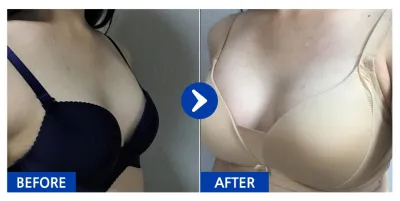 [Gangnam Unni] Phẫu thuật nâng ngực (Sebbin) / Tháng thứ 2 / Biệt danh: Jeong-ssyugi