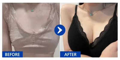 [Gangnam Unni] Nâng ngực (Sebbin Microtech) / Tháng thứ 3 / Biệt danh: Hyonni Hyonni