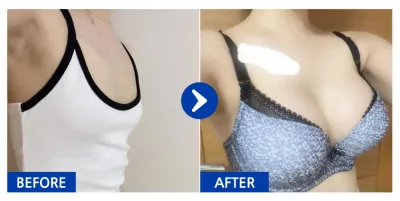 [Gangnam Unni] Phẫu thuật nâng ngực (Mentor) / Tháng thứ 4 / Biệt danh: Puhanghaha