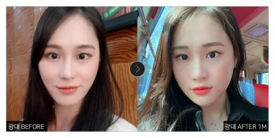 [Review Gangnam Unni] Một tháng sau phẫu thuật hạ gò má / Biệt danh: Heenimanimo