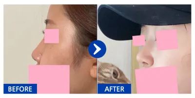 [Gangnam Unni] Phẫu thuật mũi / Tháng thứ 2 / Biệt danh: Jellylylylyl