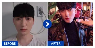 [Gangnam Unni] Phẫu thuật nâng mũi / Tháng thứ 4 / Biệt danh: Haekgyu