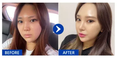 [Gangnam Unni] Phẫu thuật nâng mũi / Tháng thứ 5 / Biệt danh: Ngọc trai đen